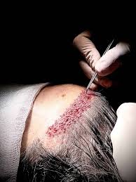 Hair Transplant